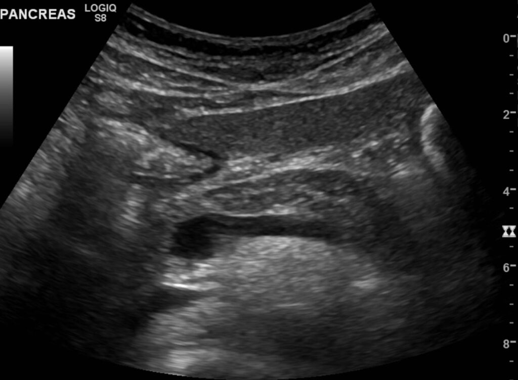 Sonogram of the pancreas showing the head, body, and uncinate process of the pancreas. The pancreatic tail is partly obscured by bowel gas shadowing. A short segment of the left hepatic lobe and duodenum are displayed anterior to the pancreas. No pancreatic duct dilatation