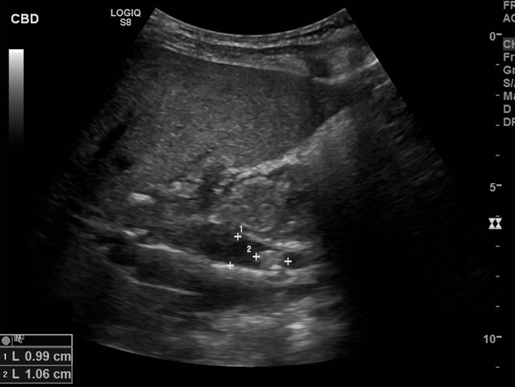 An obstructive calculus within the common bile duct. The calculus measures 11 mm and the common bile duct measures 10 mm in AP calibre