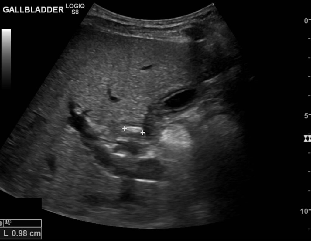 A 10 mm immoble calculus at the neck of the nearly empty gallbladder