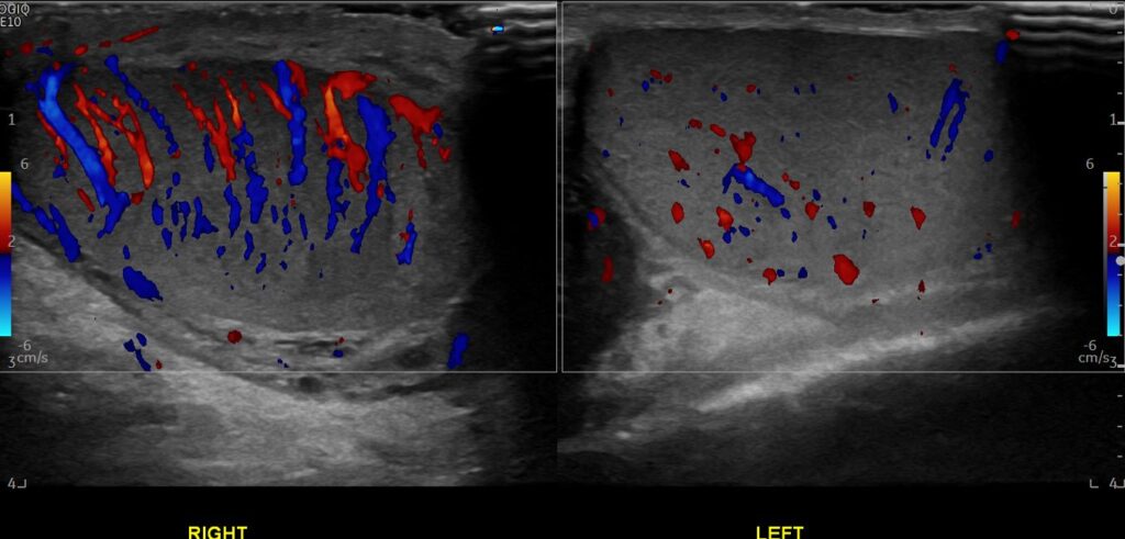 A dual-screen image of the right and left testes in colour Doppler mode. A normal left testicular vascularity can be seen