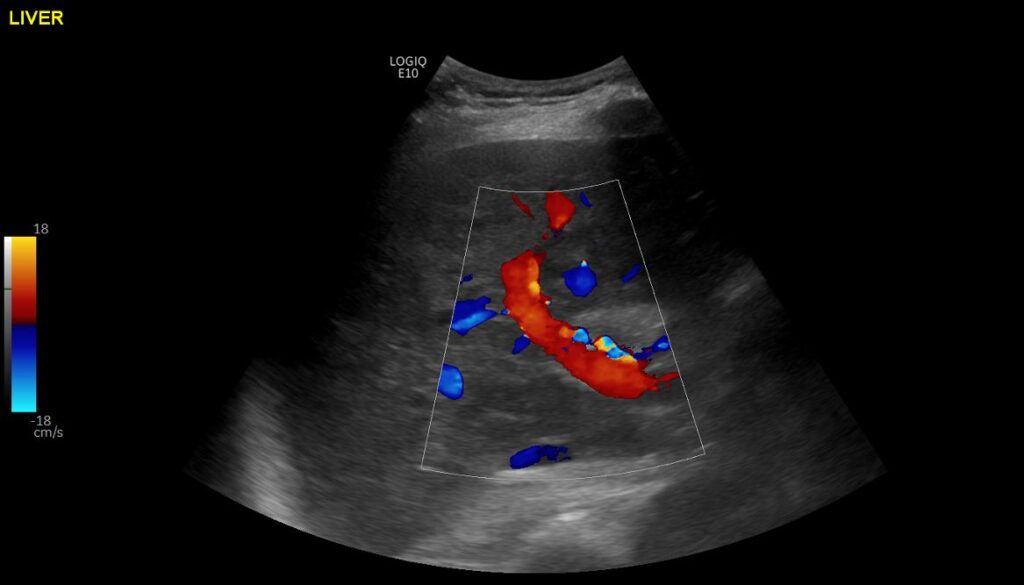 The portal vein on colour Doppler imaging showing normal hepatopetal flow