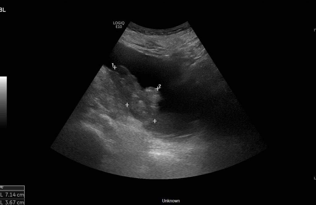 Sonogram of the partly filled urinary bladder showing a bladder wall mass(bladder tumour)