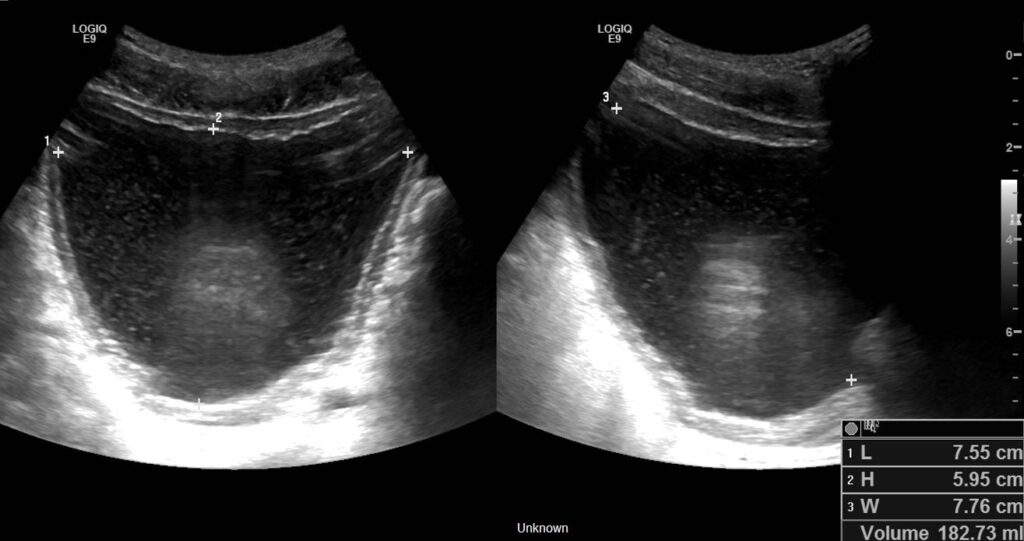 A dual-screen image of the bladder volume measurement