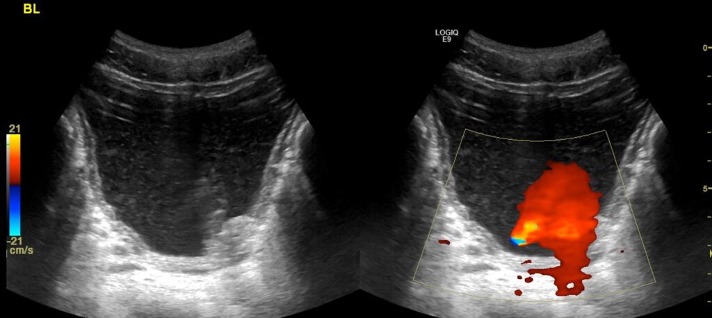 A dual-screen image of the bladder showing b-mode and colour Doppler simultaneously. Good bladder jets were recorded from both right and left ureteric orifices