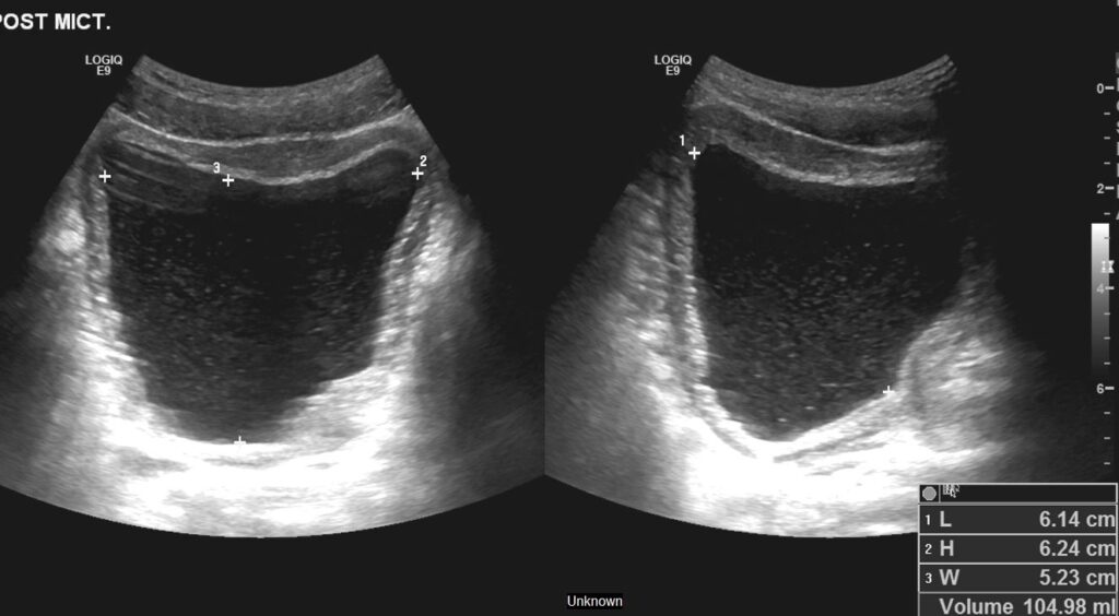 Post void with a significant amount of post void residual bladder volume of 105 ml