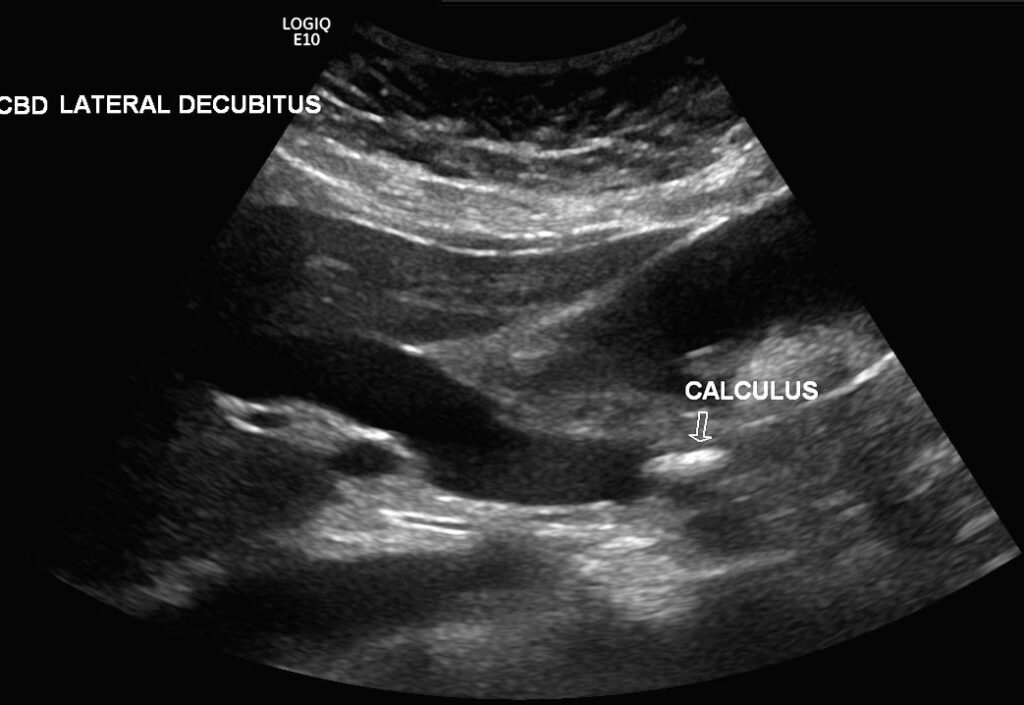 An obstructive calculus in the distal CBD