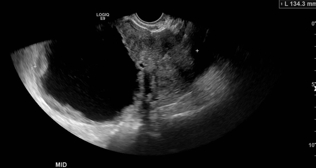 TVUSS showing a mass with cystic and solid component in the mid pelvis. The mass is a Stage II HGS cancer of the left fallopian tube