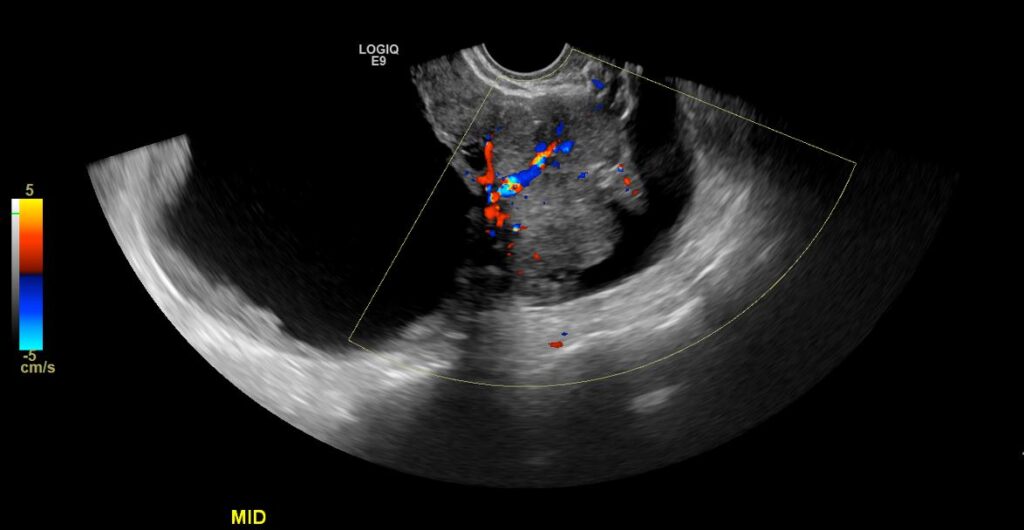 Colour Doppler imaging of the mass showing some active flow within the solid component