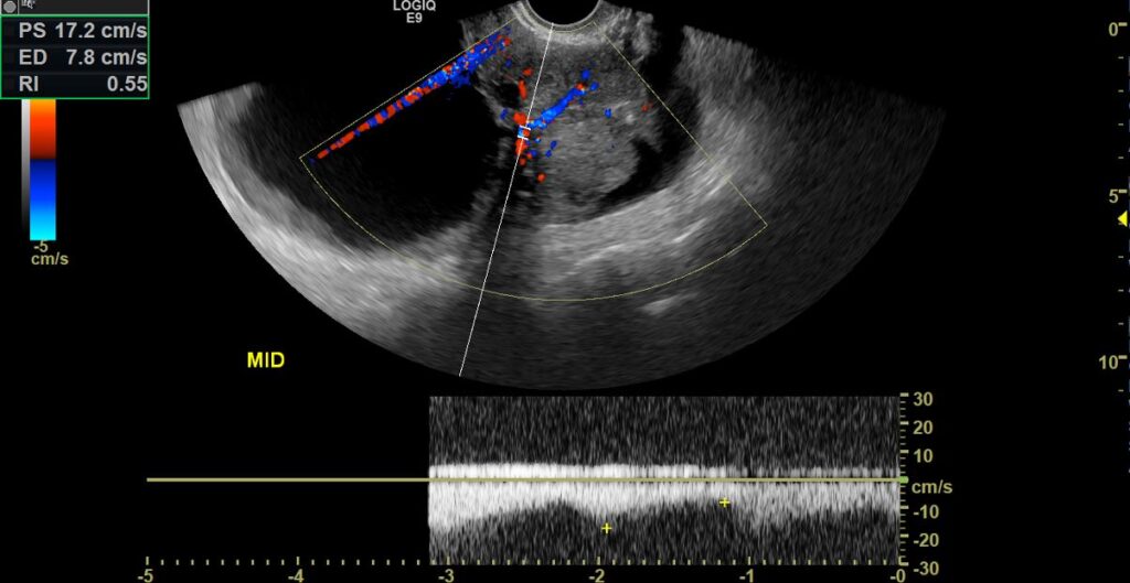 Triplex studies evaluation of the pelvic mass using b-mode, CDI, and spectral Doppler