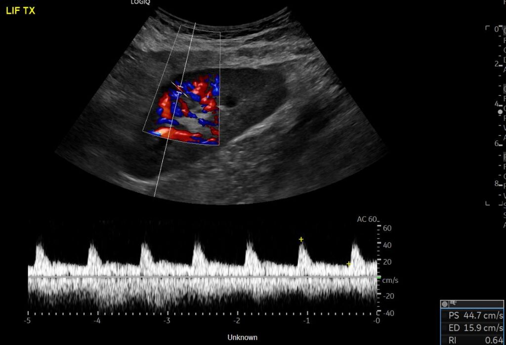 Spectral Doppler of the intrarenal artery at the interpolar region of the graft