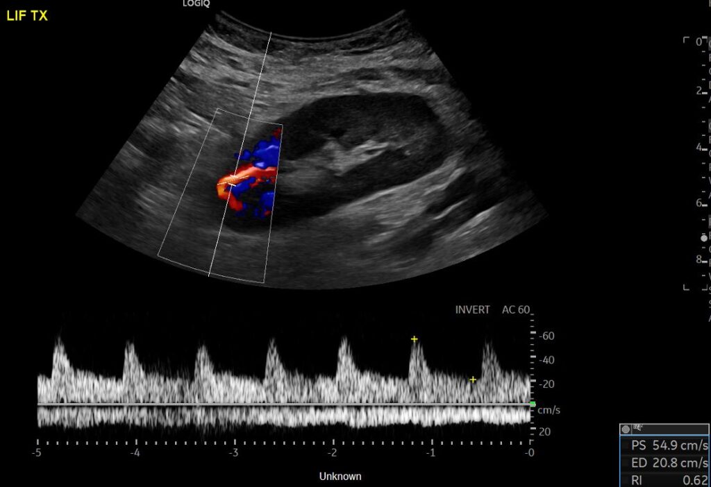 Spectral Doppler of the intrarenal artery at the upper pole