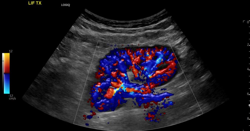  Colour Doppler imaging of the normal transplant kidney showing excellent perfusion of the graft