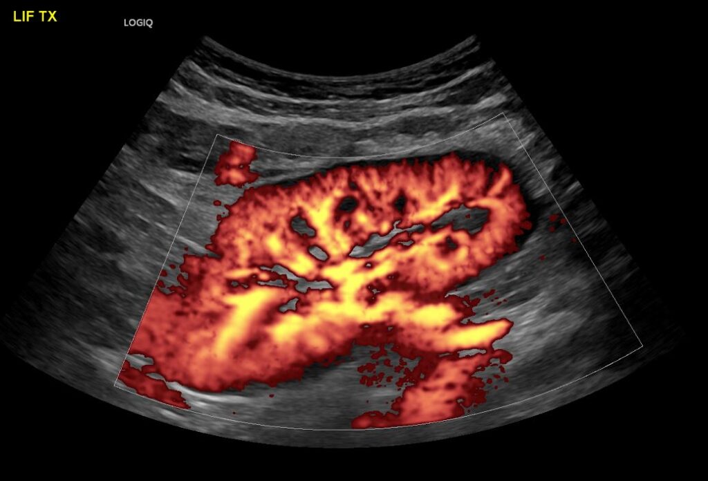 Power Doppler imaging of the normal transplant kidney (renal allograft) showing excellent perfusion of the graft