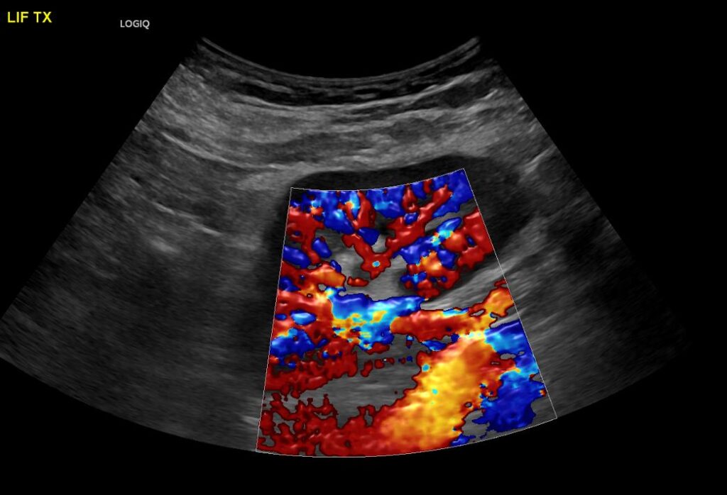 Colour Doppler imaging of the transplant (renal allograft) renal artery showing the point of anastomosis with the left external iliac artery