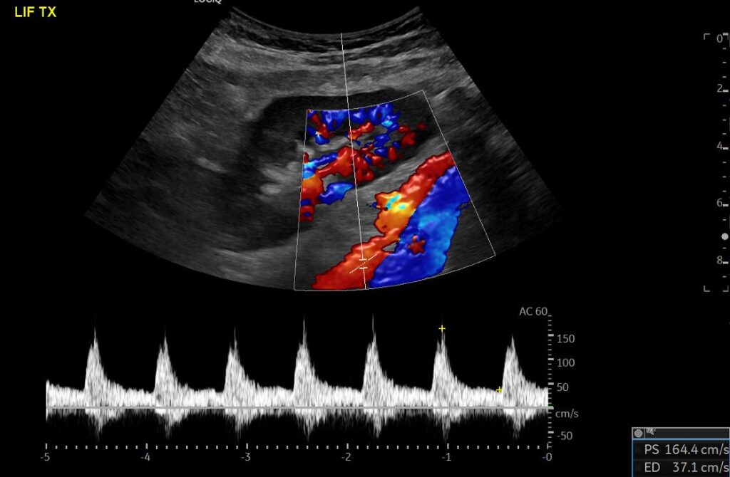 Spectral Doppler imaging of the left external iliac artery measuring the peak systolic velocity (PSV) prior to the anastomosis