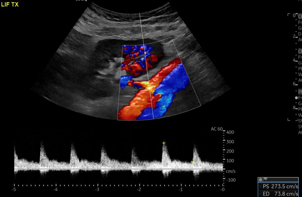  Spectral Doppler imaging of the left external iliac artery measuring the peak systolic velocity (PSV) at the level of the anastomosis