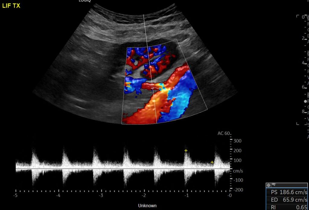 Spectral Doppler imaging of the transplant renal artery