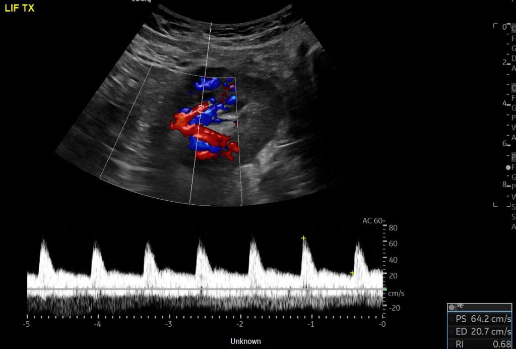 Spectral Doppler of the segmental artery within the transplant kidney