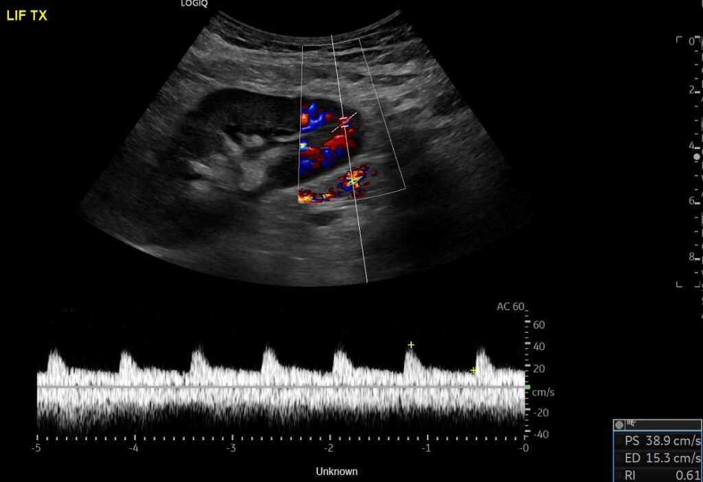  Spectral Doppler of the intrarenal artery at the lower pole