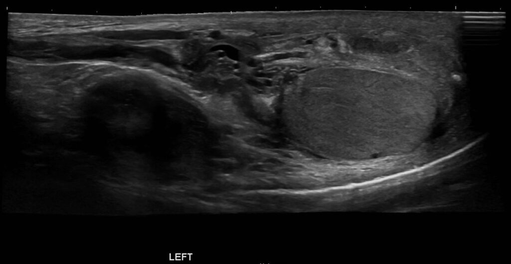 A panoramic image of the left hemiscrotum, in B-mode, showing an inflamed left epididymis