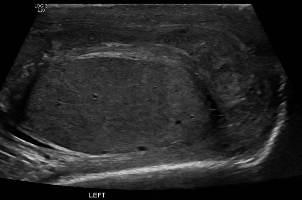 B-mode image of the inflamed left testis and left epididymis