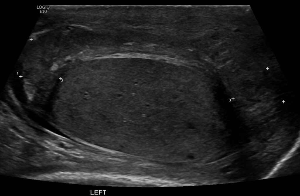 B-mode left hemiscrotum showing the bulky and inflamed left epididymis (epididymo-orchitis)