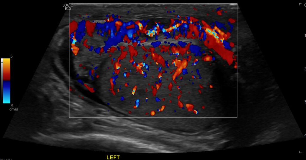 Colour Doppler imaging showing hypervascularity of the left testis and epididymis in a ‘christmas tree’ fashion