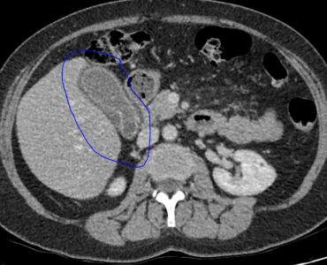 Axial CT of the gallbladder performed just prior to ultrasound showing some wall inflammation, however, no radiopaque calculus