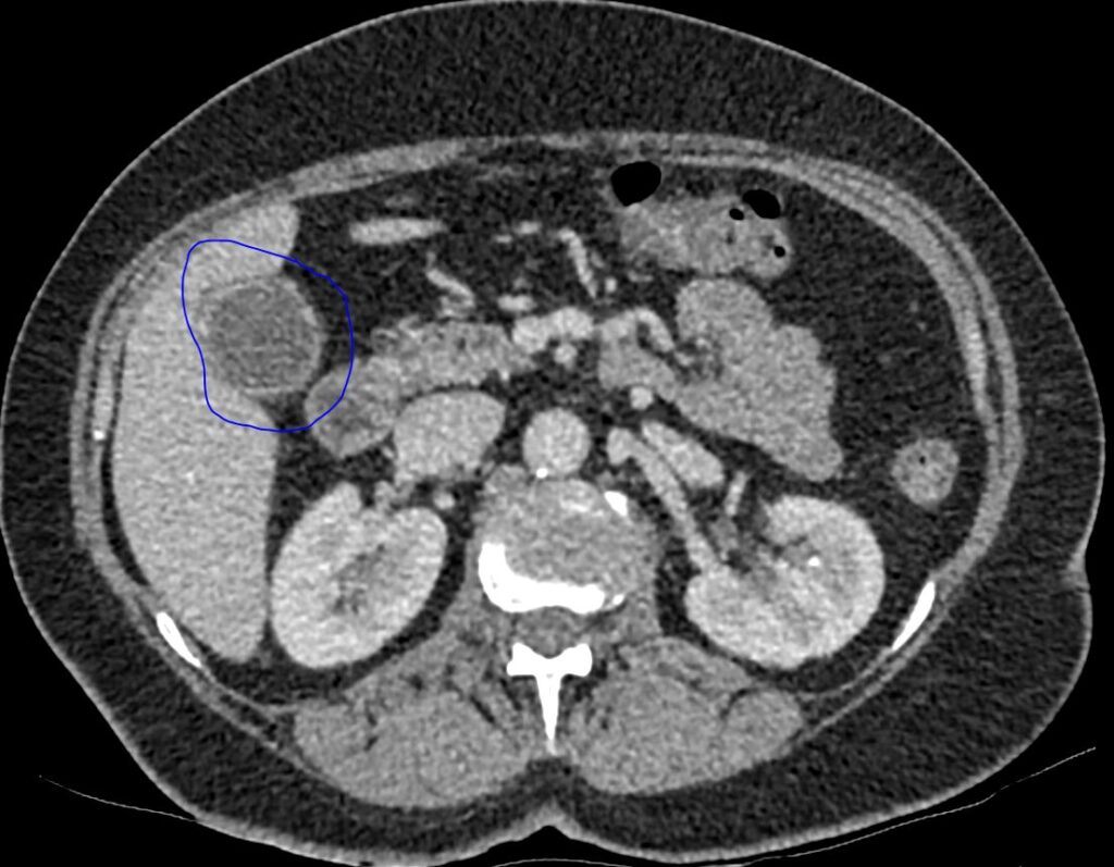 Axial CT of the gallbladder , performed recently, showing wall inflammation with no radiopaque (radiolucent calculi)  calculi within the lumen