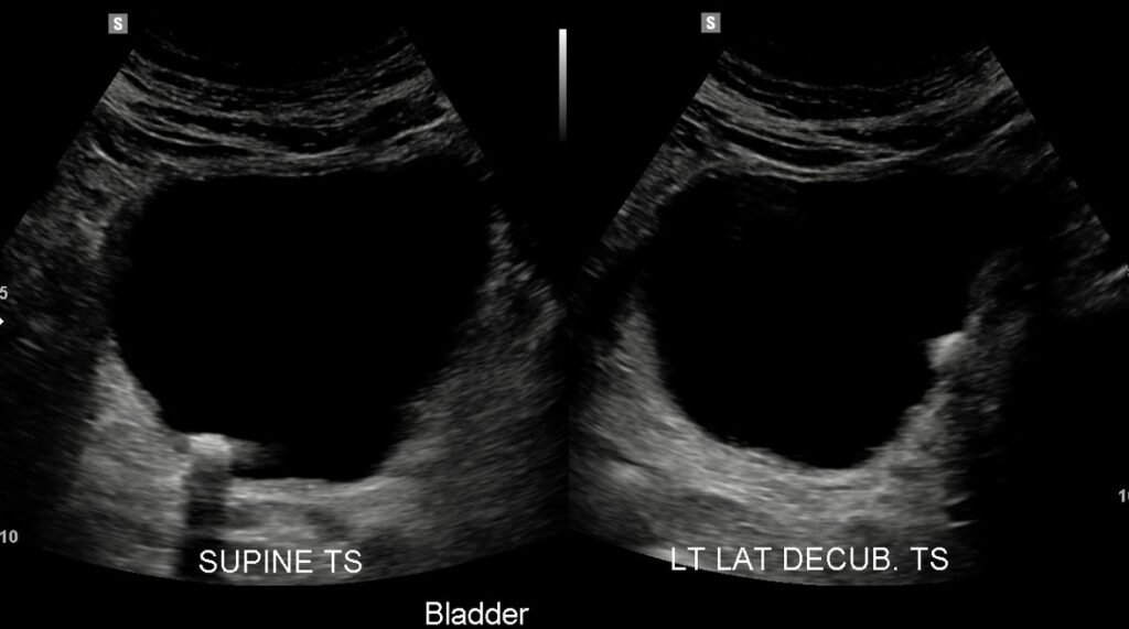 A dual-screen image of the urinary bladder with the patient initially in supine position, then asked to roll on to the left lateral decubitus position. This manoeuvre shows evidence of calculus movement which confirms that the calculus is within the bladder lumen