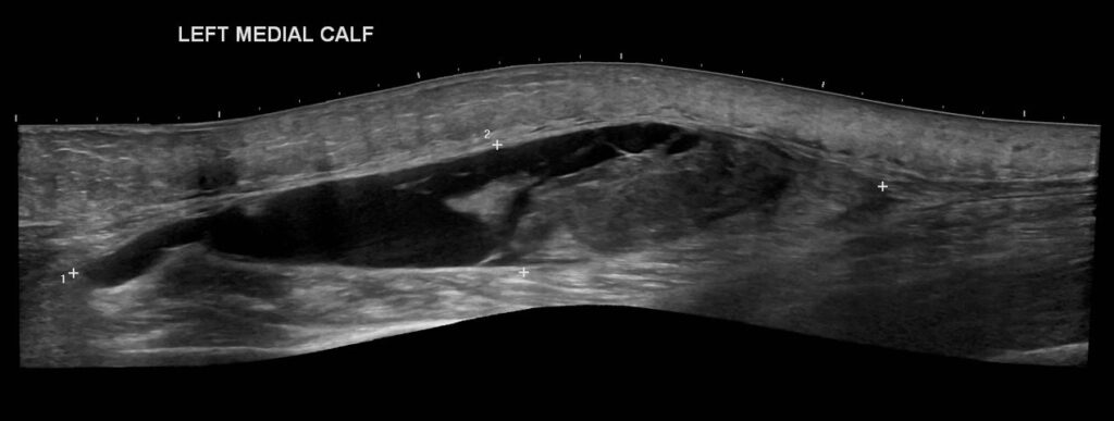 A panoramic view of the left medial calf showing the heterogeneous fluid collection in the intramuscular layer (Calf Haematoma)