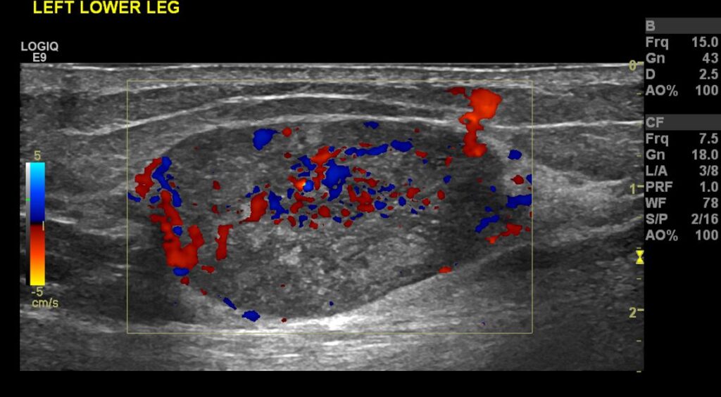 Colour Doppler imaging of the oval-shaped deep subcutaneous mass showing a significant amount of internal vascularity