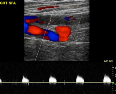 Partially occluded right superficial femoral artery (proximal)