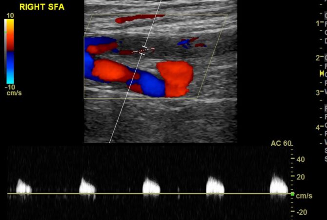 Popliteal Artery Occlusion Co-existing With Popliteal Vein DVT » Sonohive