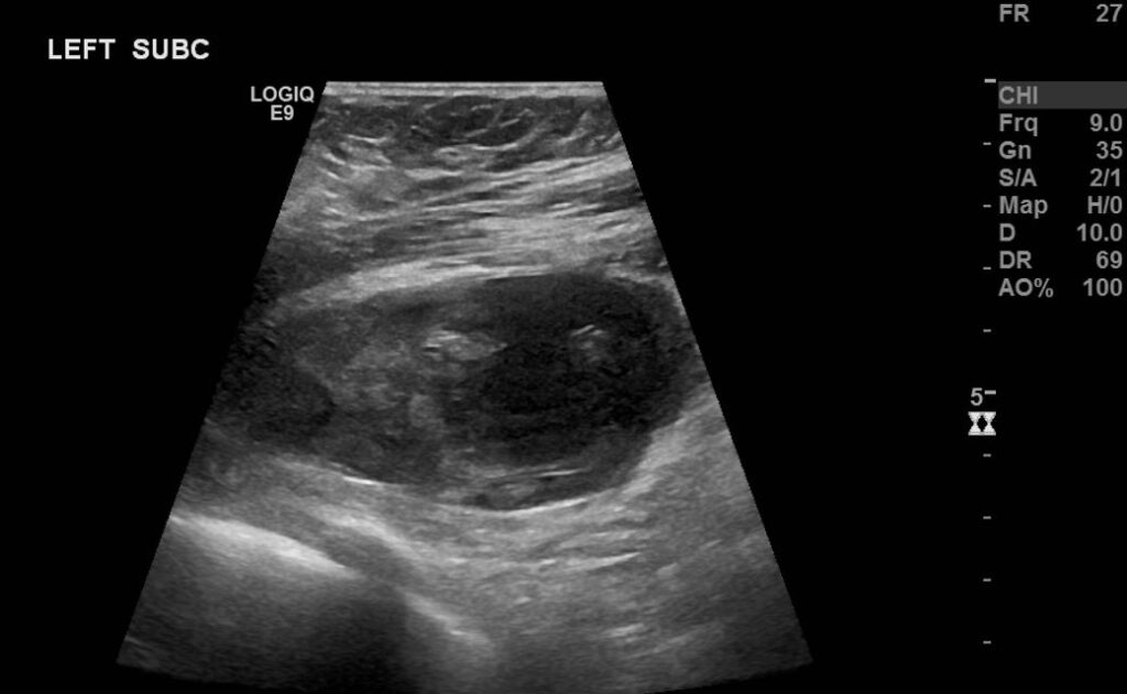 B-mode sonogram, acquired using a 9 MHz linear transducer, showing the subpectoral haematoma