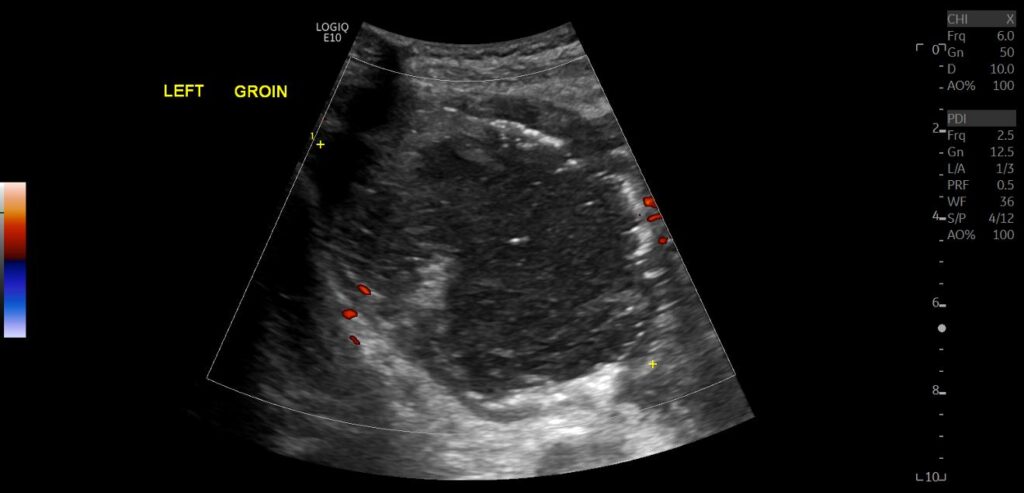 Power Doppler imaging showing no evidence of vascularity within the groin abscess