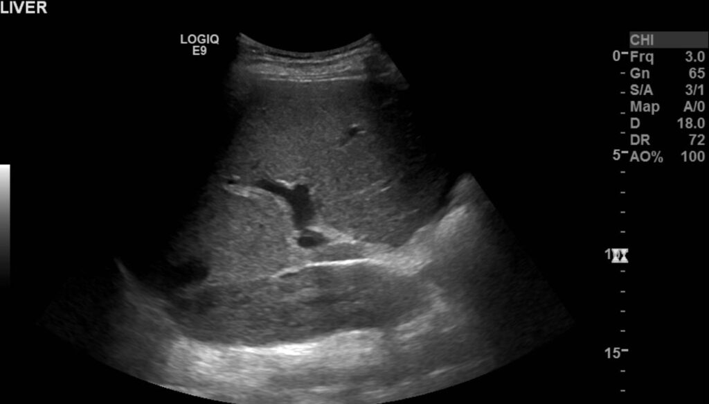 Right upper quadrant showing the liver and the occluded IVC posteriorly