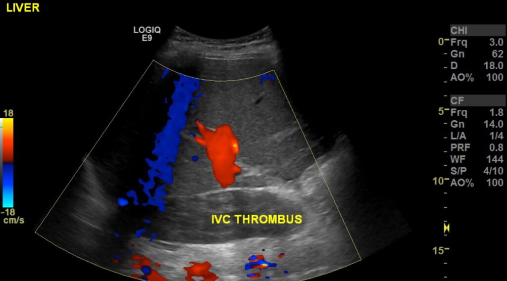 Colour Doppler Imaging showing the occluded IVC