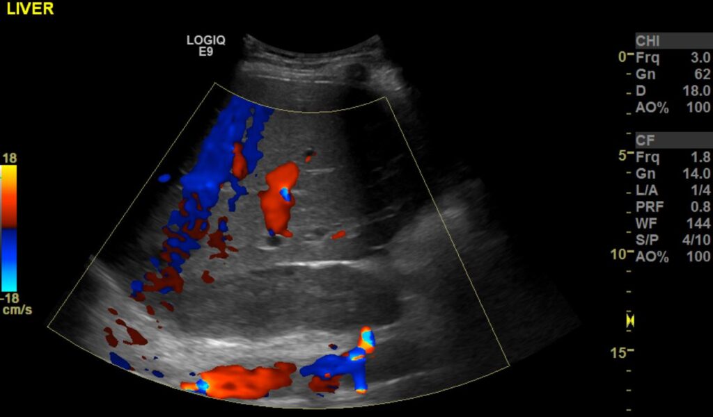 Colour Doppler Imaging showing the occluded (tumour thrombus) IVC