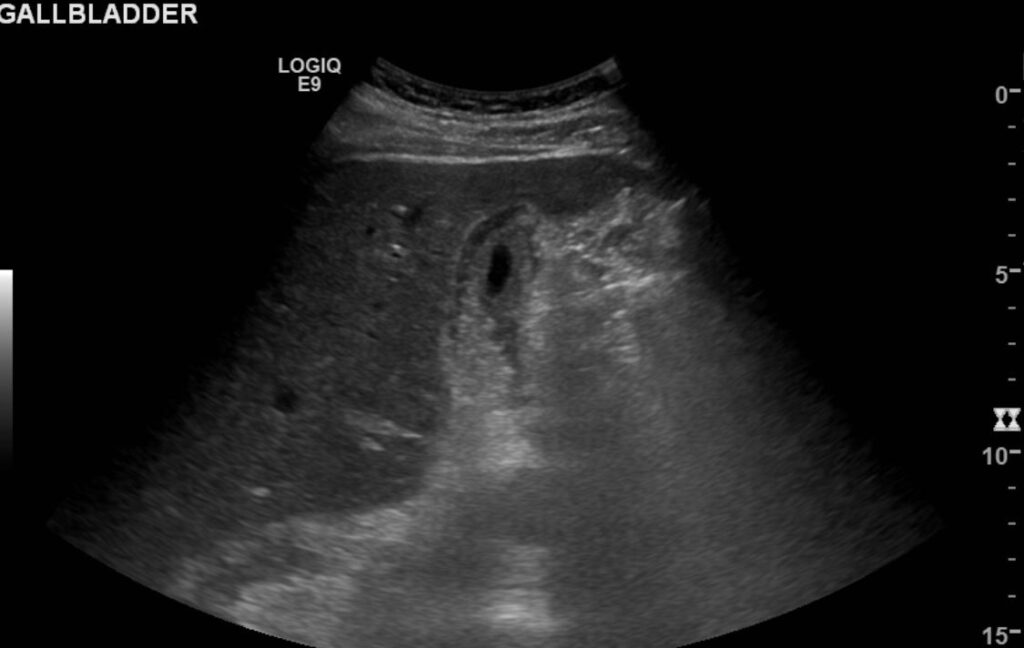 Empty oedematous gallbladder, probably due to the ascites