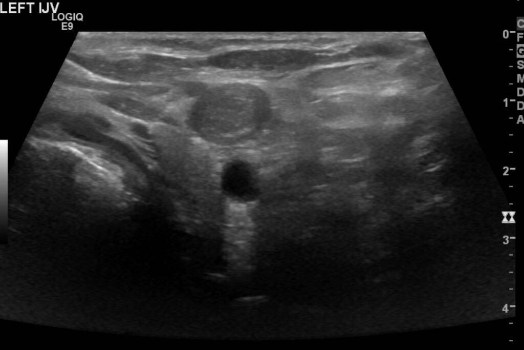 Axial segment of the IJV showing the occlusive thrombus