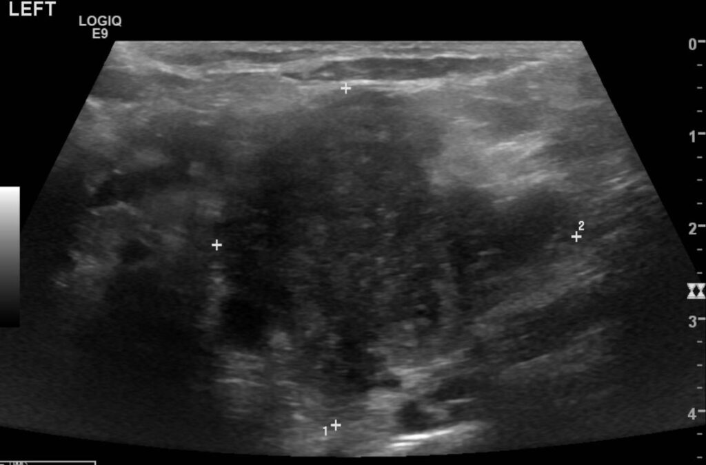 A heterogeneous left supraclavicular mass