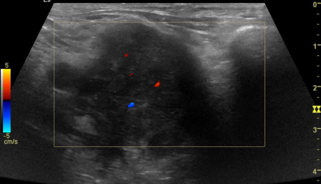 CDI showing evidence of internal vascularity in the left supraclavicular mass