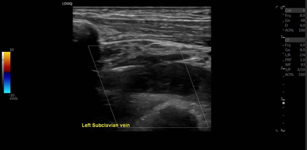 Colour Doppler imaging showing an absence of flow signal in the subclavian vein