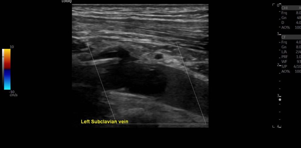 Colour Doppler imaging showing an absence of flow signal in the subclavian vein