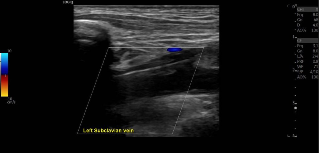 Colour Doppler imaging showing an absence of flow signal in the subclavian vein