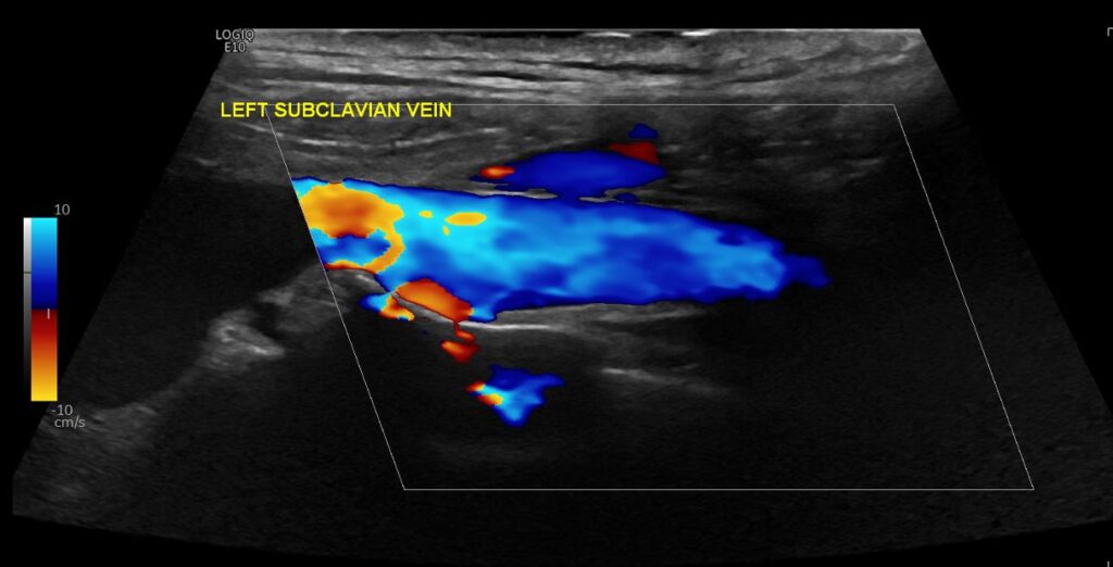 CDI showing flow in the left subclavian vein