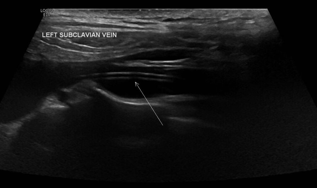  B-mode showing the PICC line in the subclavian vein (arrow)