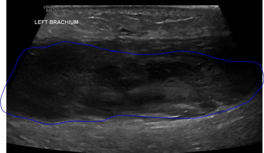 Left arm intramuscular haematoma on B-mode