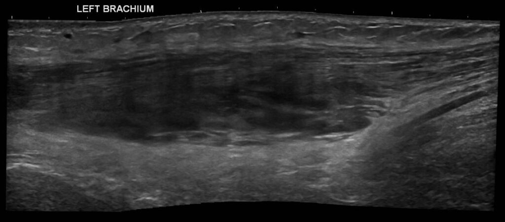 Panoramic view of the intramuscular haematoma